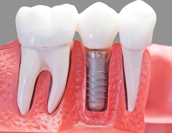 Современный курс лечения зубной полости. Имплантация зубов